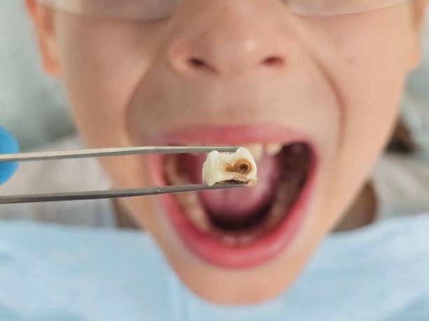 Best Emergency Root Canal Treatment in Troutman, NC